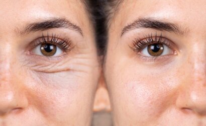 Sparčiai populiarėja akių vokų plastikos operacijos: ryžtasi ne tik dėl grožio, bet ir dėl sveikatos