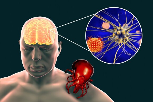 Tick-borne encephalitis.