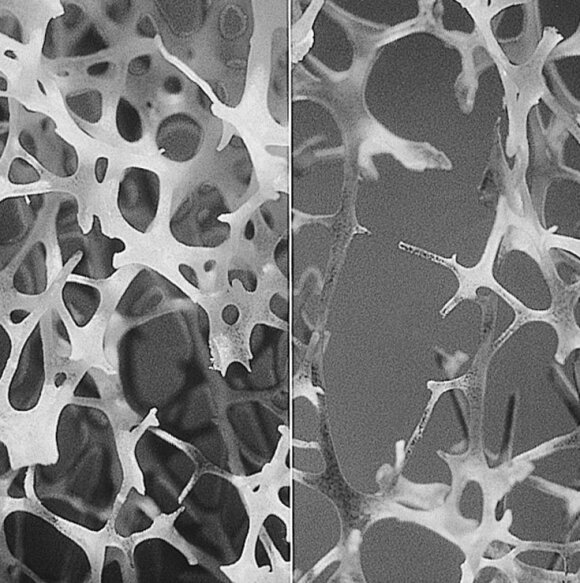 Normali kaulo struktūra ir osteoporozės paveikto kaulo struktūra. Gtirouflet/Wikimedia nuotr.